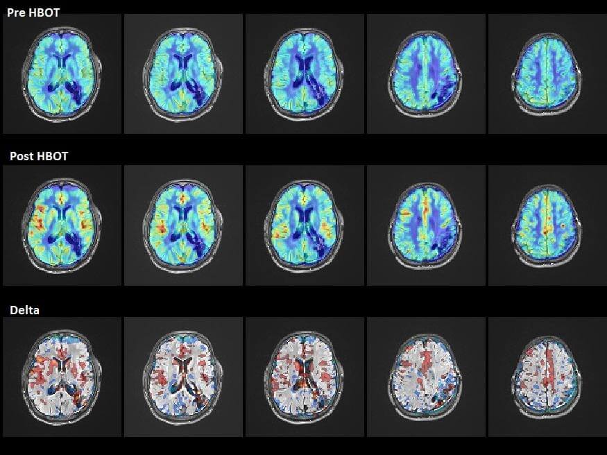 Oxygen Therapy for Stroke Treatment