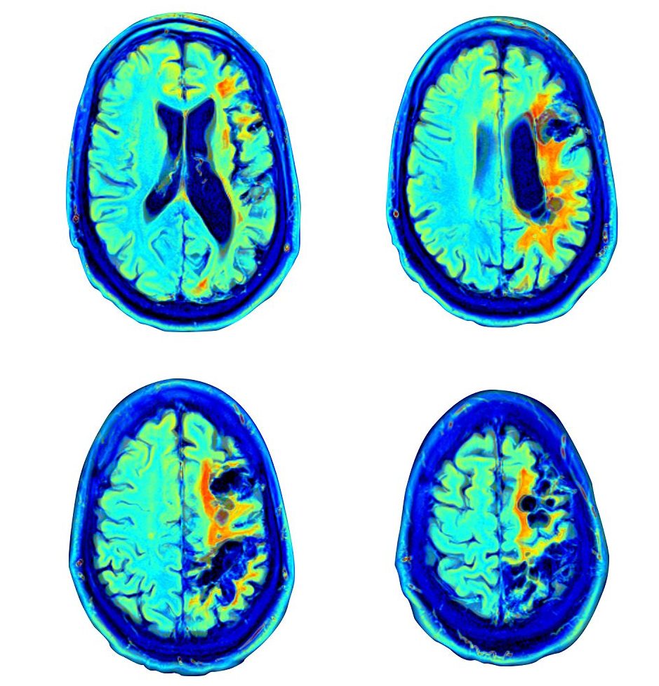 Brain scans of a post-stroke patient