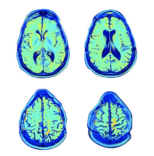 Finally, A Blood Test for Traumatic Brain Injury