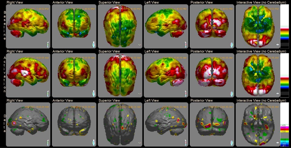 advanced-brain-imaging