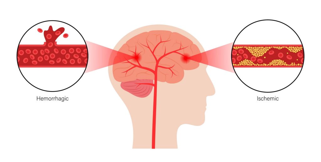 Hemorrhagic strole deals