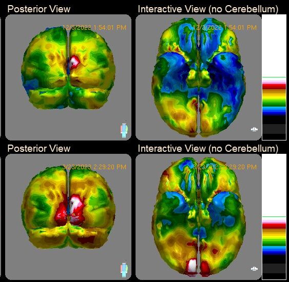 Neuroimaging