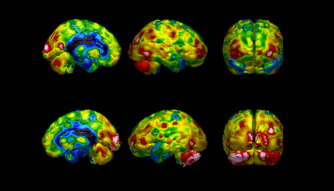 SPECT-scans