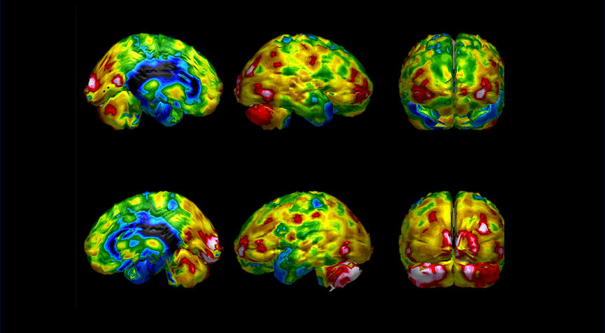 How Does A Spect Scan Work